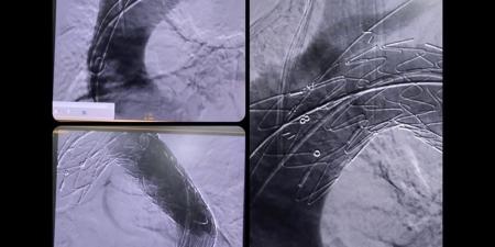 نجاح جديد لمستشفى مصر للطيران في ترميم الشريان الأورطي الصدري