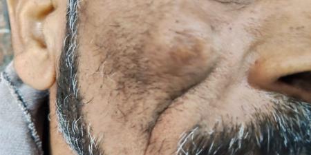 الدقهلية:
مستشفى
السنبلاوين
تُجري
6
عمليات
جراحة
تجميل
دقيقة
لحالات
معقدة