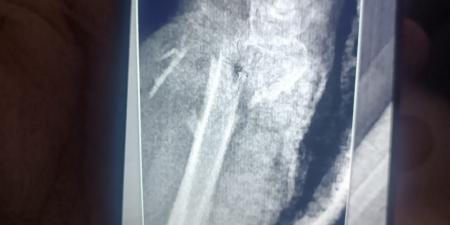 مستشفى
      الفيوم
      العام
      تنقذ
      حياة
      سيدة
      مسنّة
      بعد
      سقوط
      من
      علو
      وتجري
      جراحة
      ميكروسكوبية
      دقيقة
      باليد