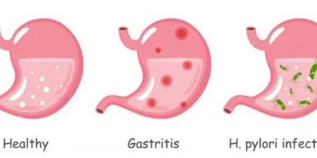 فمك
      يكشف
      الخطر..
      علامات
      لا
      تهملها
      لـ"جرثومة
      المعدة"